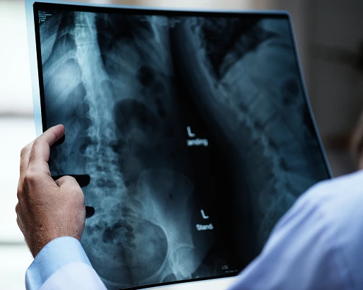 Spinal Hematoma