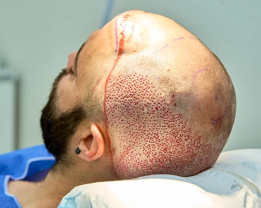 Subdural Hematoma
